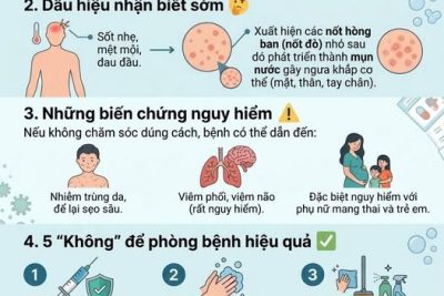 [CẢNH BÁO SỨC KHỎE] CHỦ ĐỘNG PHÒNG CHỐNG BỆNH THỦY ĐẬU 🛡️🌡️ Bệnh Thủy đậu (hay còn gọi là trái rạ) đang vào mùa cao điểm. Để bảo vệ bản thân và gia đình, Liên đội trường Tiểu học Phan Chu Trinh, xã Nam Đà, tỉnh Lâm Đồng xin gửi đến quý  phụ huynh, các em học sinh những thông tin quan trọng sau: 1. Bệnh Thủy đậu là gì? ❓ Là bệnh truyền nhiễm cấp tính do virus Varicella-Zoster gây ra. Bệnh rất dễ lây lan qua đường hô hấp (hắt hơi, ho) hoặc tiếp xúc trực tiếp với dịch từ nốt phỏng. 2. Dấu hiệu nhận biết sớm 🧐 Sốt nhẹ, mệt mỏi, đau đầu. Xuất hiện các nốt hồng ban (nốt đỏ) nhỏ, sau đó phát triển thành mụn nước gây ngứa khắp cơ thể (mặt, thân, tay chân). 3. Những biến chứng nguy hiểm ⚠️ Nếu không chăm sóc đúng cách, bệnh có thể dẫn đến: Nhiễm trùng da, để lại sẹo sâu. Viêm phổi, viêm não (rất nguy hiểm). Đặc biệt nguy hiểm với phụ nữ mang thai và trẻ em. 4. 5 “Không” để phòng bệnh hiệu quả ✅ Tiêm vắc xin: Đây là biện pháp phòng bệnh hiệu quả nhất (đạt trên 95%). Vệ sinh cá nhân: Thường xuyên rửa tay bằng xà phòng, sử dụng nước muối sinh lý để nhỏ mũi, họng. Giữ sạch môi trường: Lau chùi vật dụng, đồ chơi của trẻ bằng chất sát khuẩn. Hạn chế tiếp xúc: Người bệnh cần được nghỉ ngơi tại nhà, cách ly từ 7–10 ngày để tránh lây lan cho cộng đồng. Không tự ý dùng thuốc: Khi có dấu hiệu bệnh, hãy đến ngay cơ sở y tế gần nhất để được tư vấn, không tự ý đắp lá hay dùng thuốc nam chưa rõ nguồn gốc. 📢 Vì sức khỏe cộng đồng, hãy chia sẻ thông tin này đến người thân và bạn bè!
